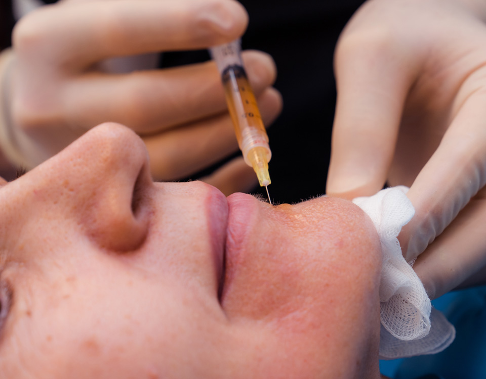 Siringa Trattamento PRP Plasma Ricco di Piastrine