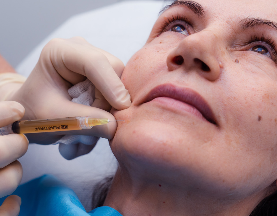 Siringa Trattamento PRP Plasma Ricco di Piastrine