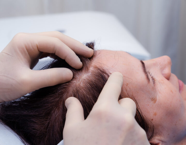 Donna con cute con pochi capelli