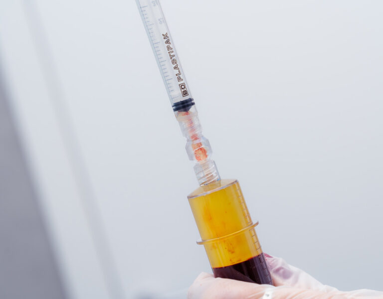 Siringa Trattamento PRP Plasma Ricco di Piastrine