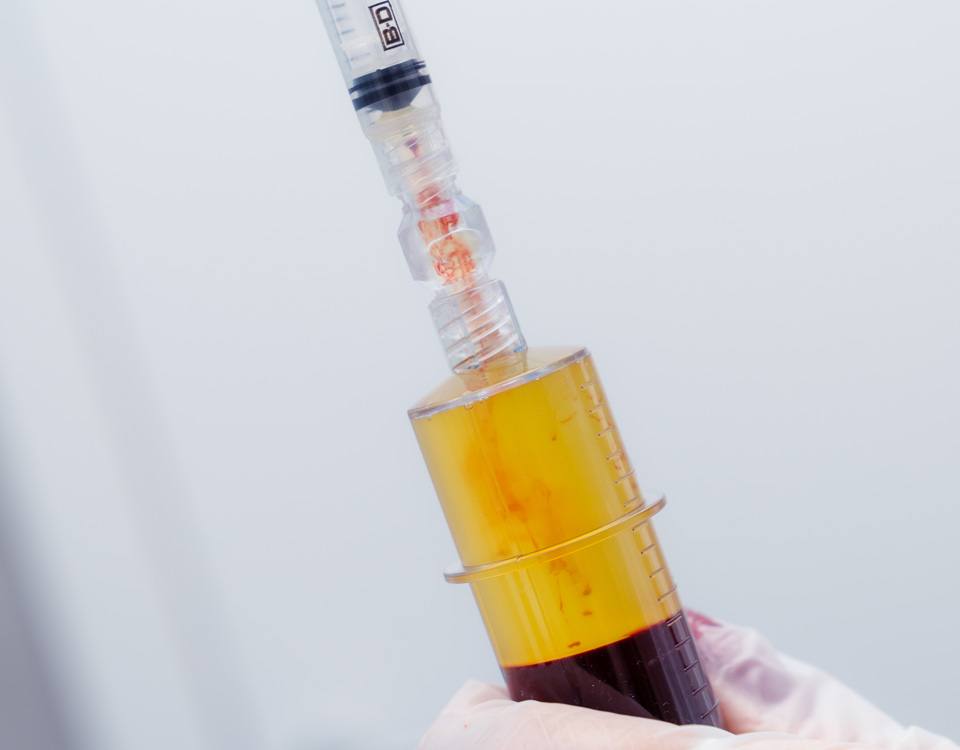 Siringa Trattamento PRP Plasma Ricco di Piastrine