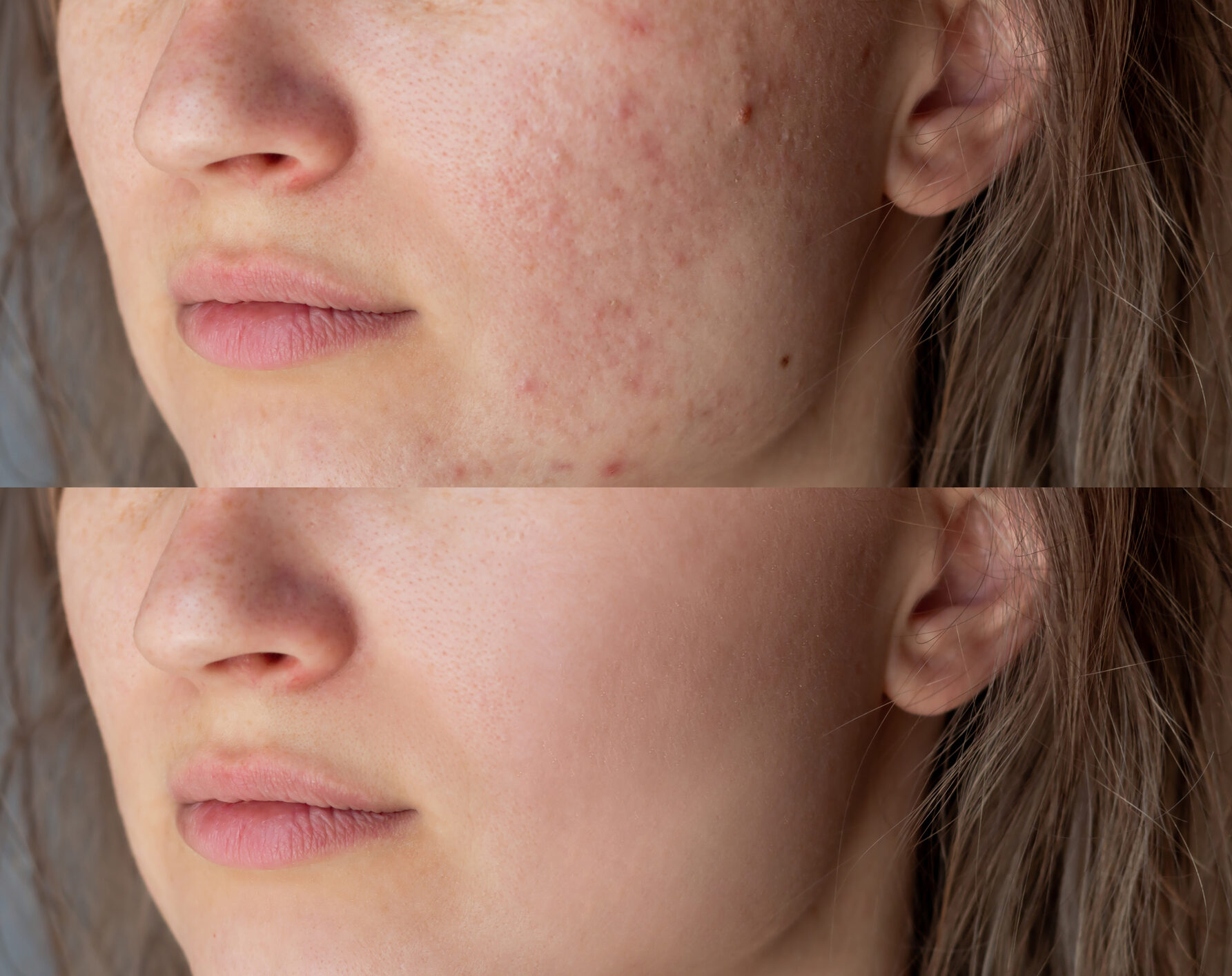 Prima e dopo di un trattamento sulla pelle acneica