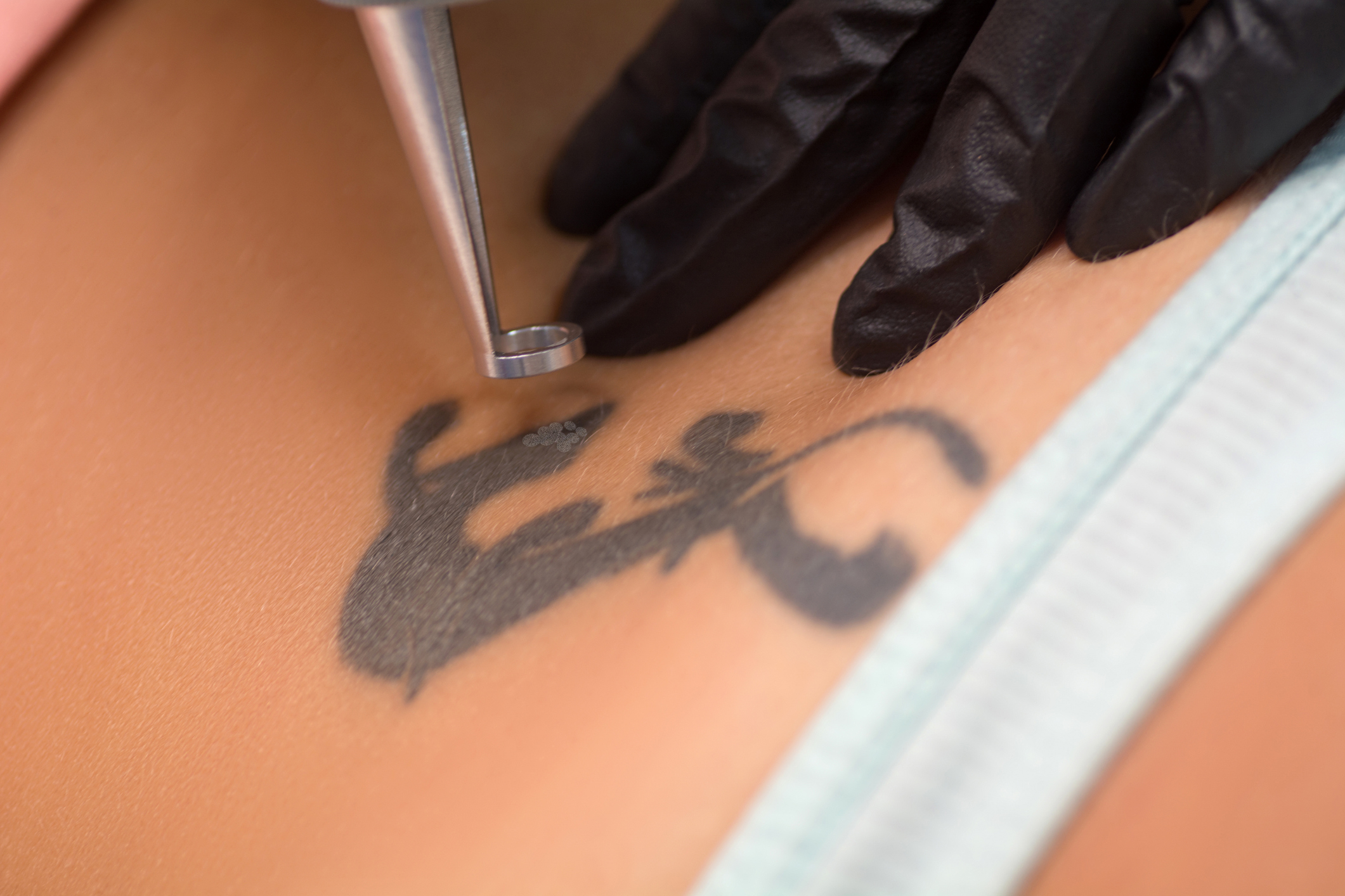 Rimozione tatuaggio con laser